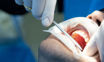 Exodontia dos Terceiros Molares: Dente do Siso 3