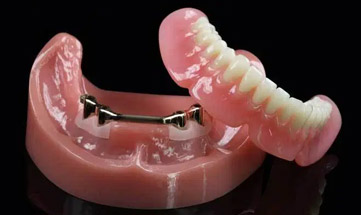 Próteses Totais Removíveis sobre Implantes: Overdentures 3