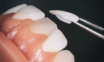 Prótese Fixa Dento Suportada 2