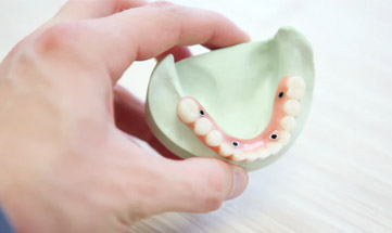 Prótese Total Fixa sobre Implantes: Protocolo 1